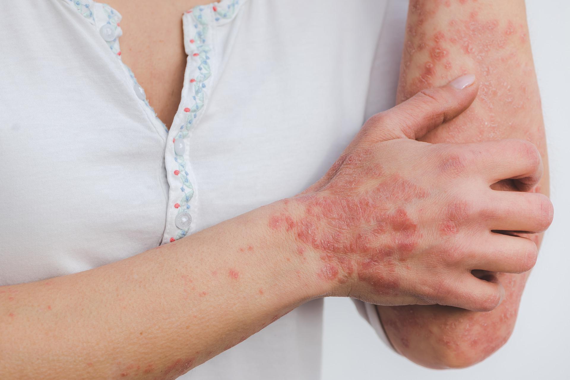 Allo Zonchello un Centro per la diagnosi e la cura della Psoriasi Allo Zonchello un Centro per la diagnosi e la cura della Psoriasi