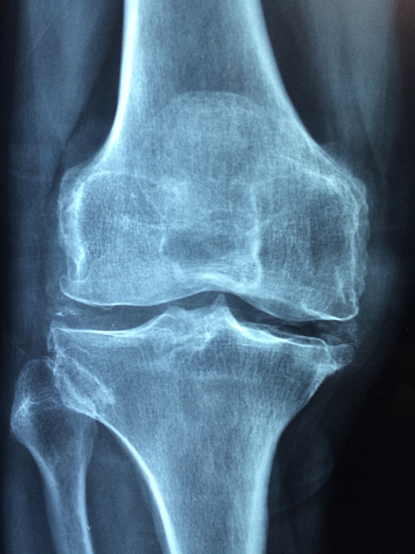 Giornata mondiale dell’Osteoporosi